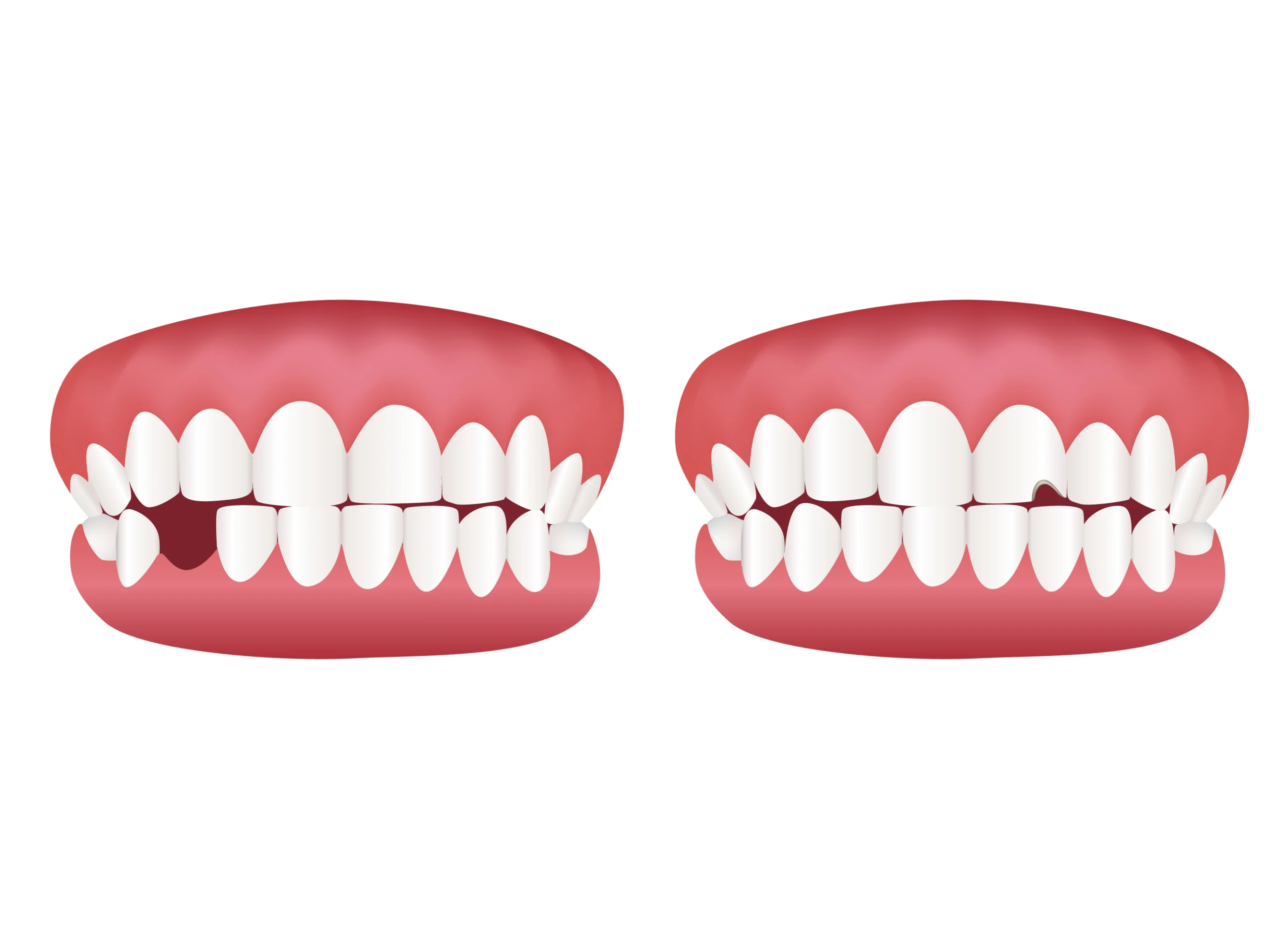 Detailed Dental Illustration Clipart Showing Tooth Gap and Dental Alignment