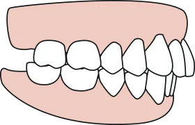 Medical Illustration of Dental Alignment Showing Tooth Positioning Clipart