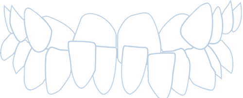 Teeth what is smartwire how does work clipart transparent