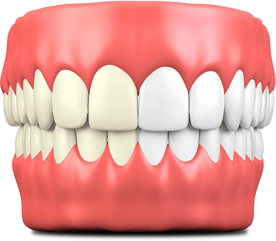 Teeth whitening newton ma the dental specialists clipart transparent