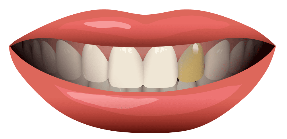 Teeth why do have discolored tooth clipart logo